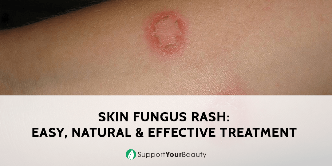 Skin Fungus Rash: Easy, Natural, and Effective Treatment